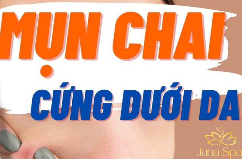 Mụn chai là gì? Vì sao mụn trở nên cứng và khó biến mất