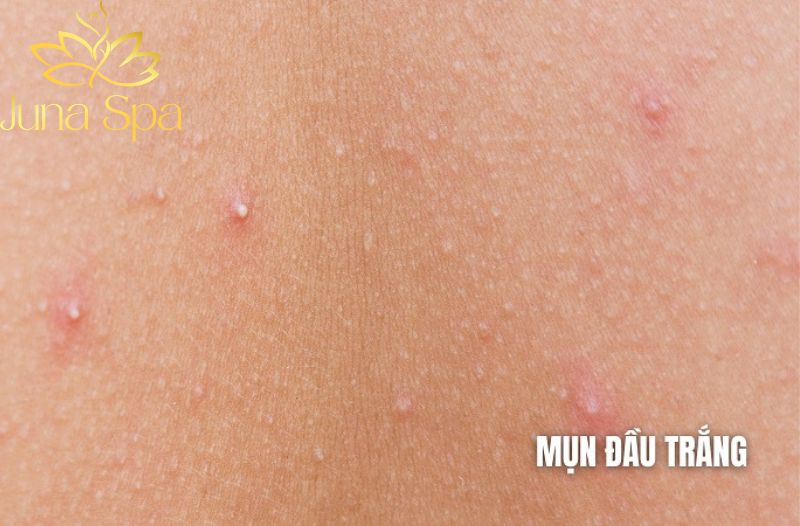 mụn đầu trắng