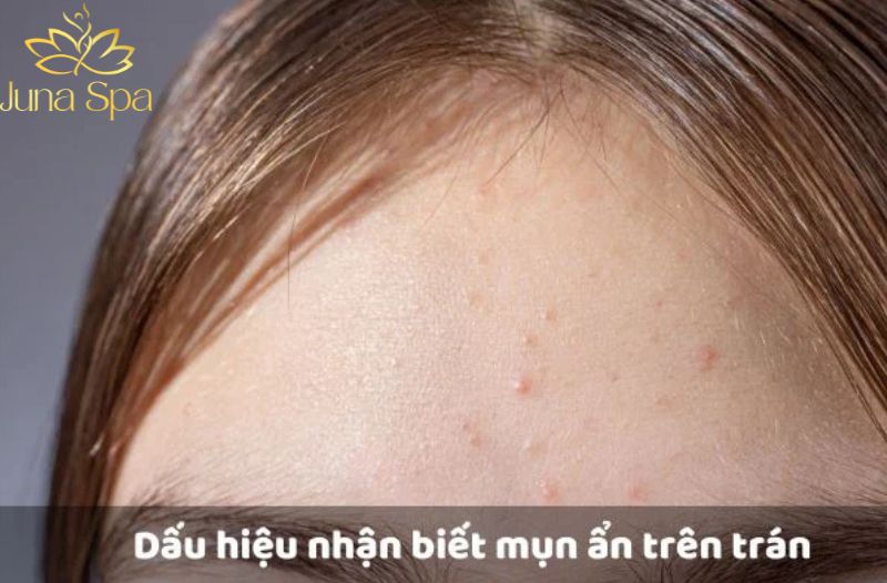 Mụn ẩn trên trán là gì và đặc điểm nhận biết