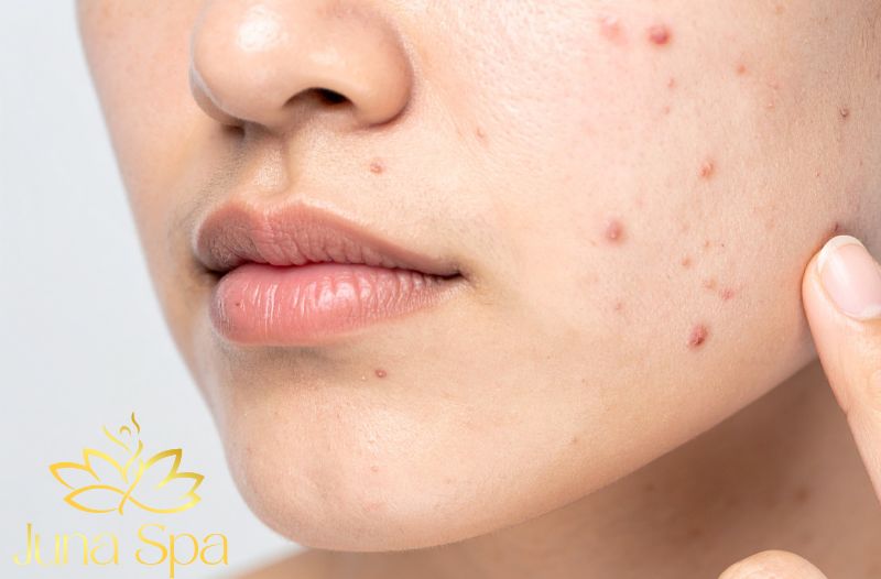 Cách sử dụng serum trị thâm mụn để đạt hiệu quả tối ưu