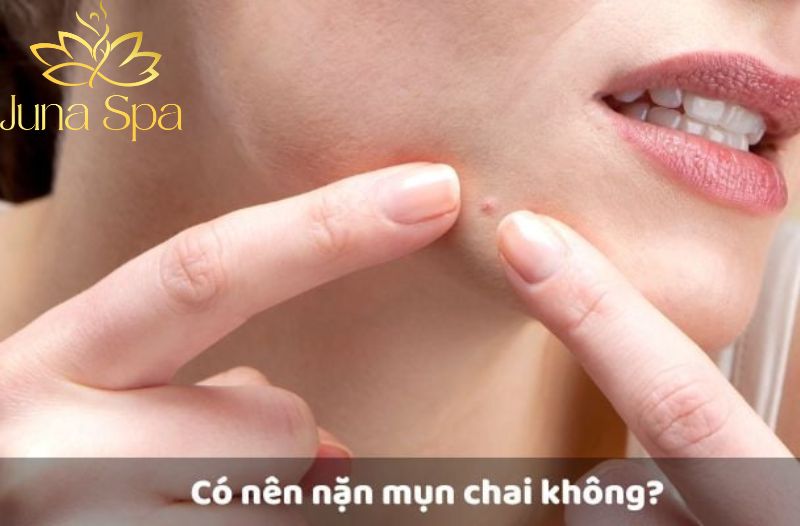 Mụn chai có tự hết không? Giải đáp chi tiết và cách giúp da dần mịn hơn