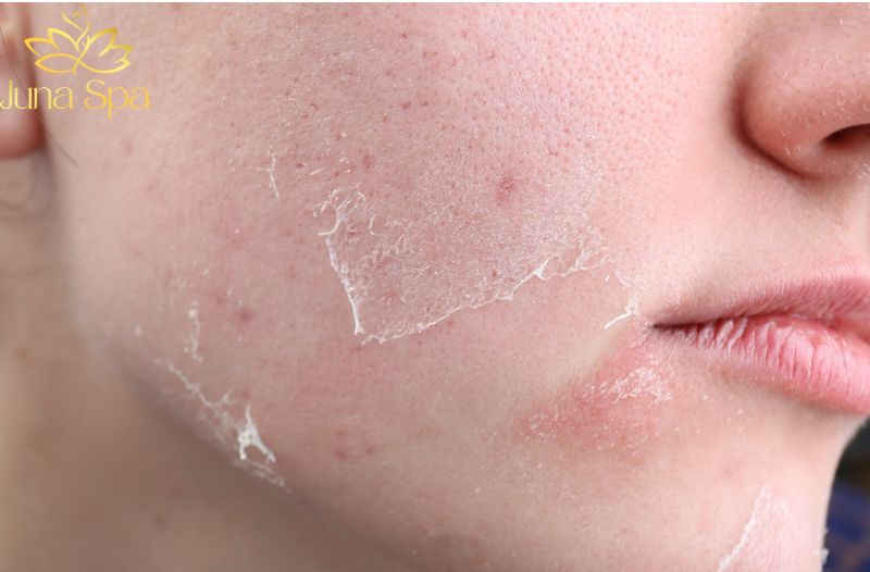 Dấu hiệu da châm chích khi skincare không hẳn là kích ứng