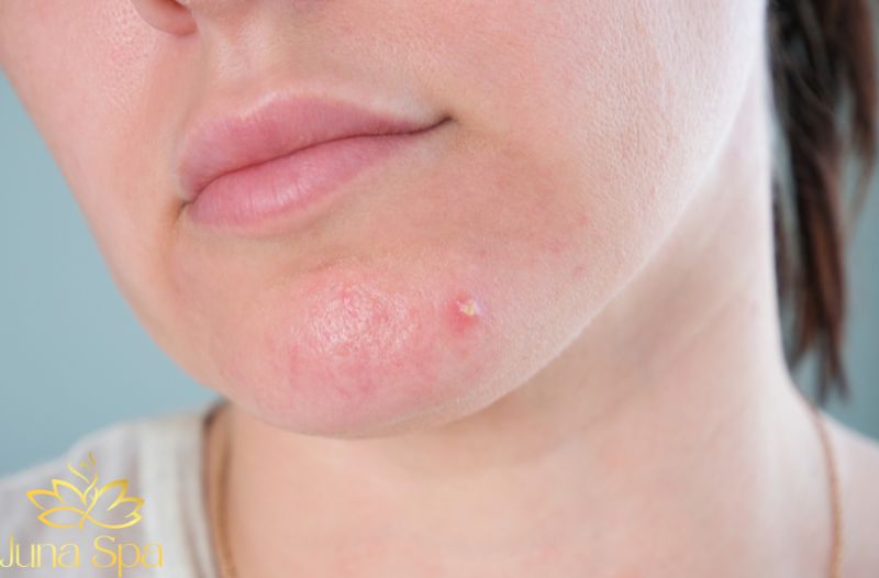 Mụn ẩn ở cằm - Gắn liền với sinh hoạt và sự thay đổi của cơ thể