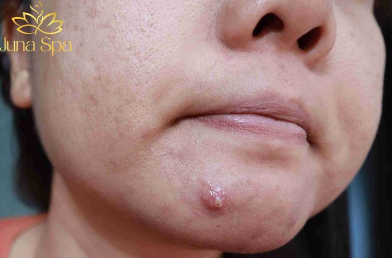 Nguyên nhân khiến mụn chai khó cải thiện hơn các loại mụn khác