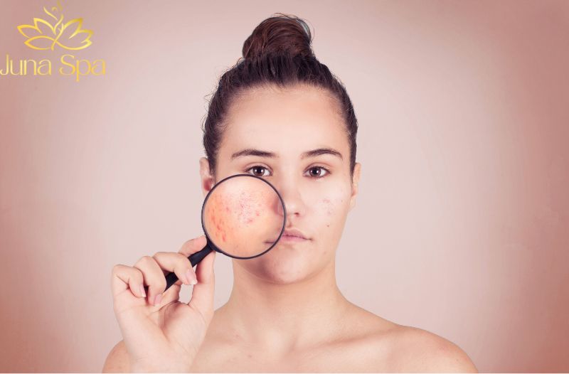 Vì sao da thường nổi mụn trong dịp Tết
