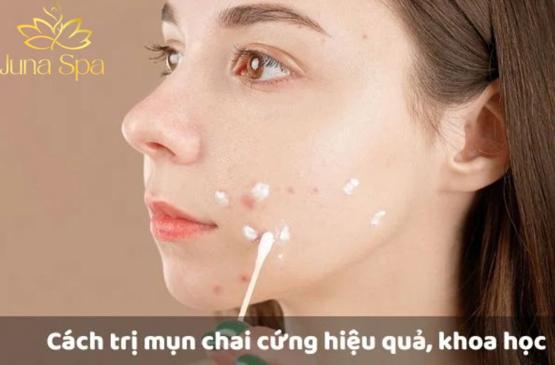 Cách giúp da cải thiện tình trạng mụn chai theo hướng nhẹ nhàng