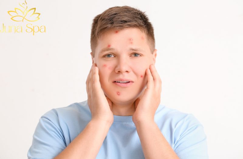 Những nguyên nhân phổ biến khiến mụn đầu trắng tái diễn