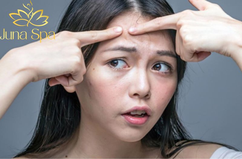 Cách chăm sóc giúp vùng trán giảm mụn ẩn và mịn màng hơn