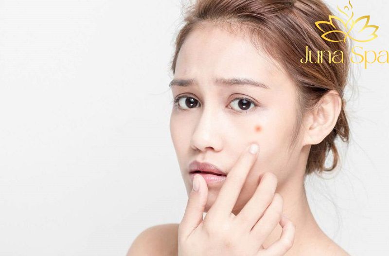 Nguyên nhân gây mụn bị chai