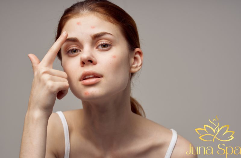 Vì sao mụn ẩn ở trán thường khó cải thiện nhất?
