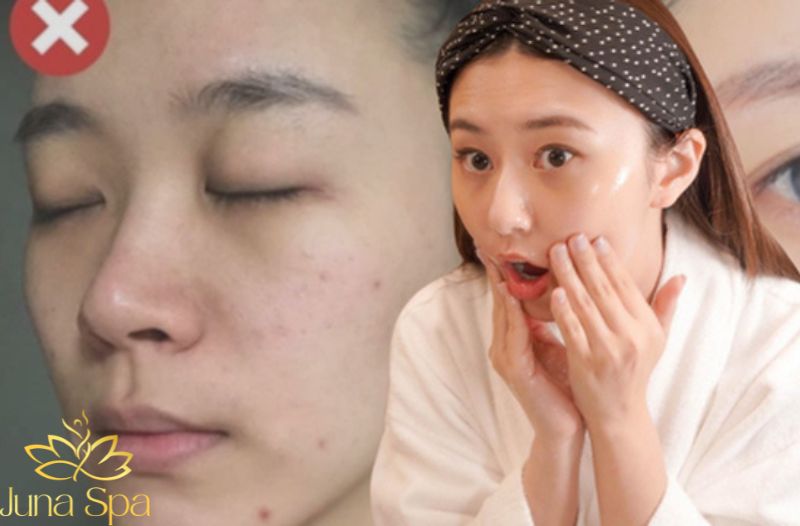Chạy theo liệu trình mạnh khi da chưa sẵn sàng