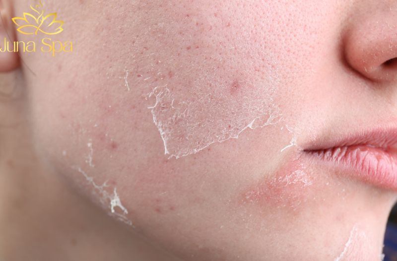 Mẹo chăm sóc da khi da bong tróc nhẹ do ngồi máy lạnh nhiều