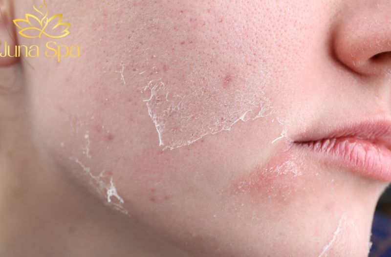 Mẹo chăm sóc da khi da bong tróc nhẹ do ngồi máy lạnh nhiều
