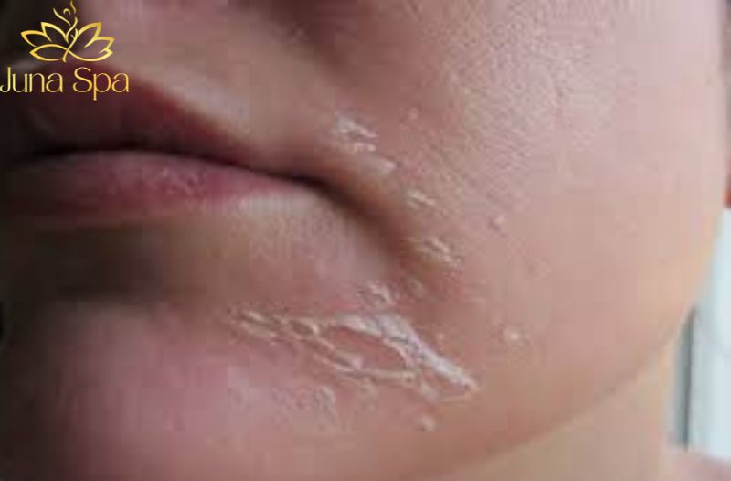 Da khô dễ bong tróc sau Tết: Cách chăm da để lấy lại độ ẩm tự nhiên