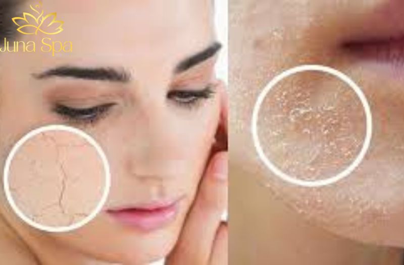 Chăm sóc da khô sau Tết nên bắt đầu từ đâu