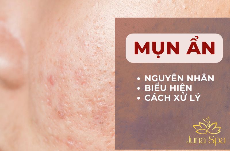Mụn ẩn ngày càng dày: Cảnh báo da đang bít tắc và mất cân bằng