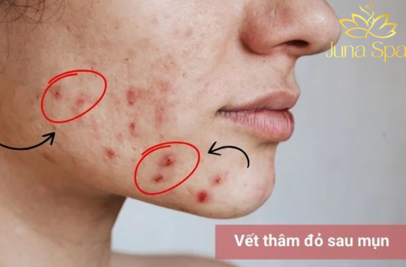 Thâm đỏ sau mụn - Khi da vẫn còn phản ứng viêm