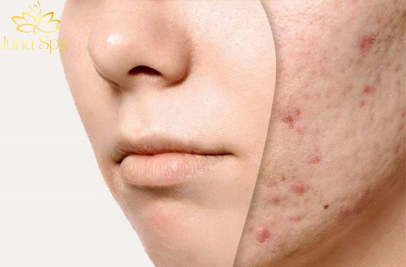 Dấu hiệu nhận biết da đang bít tắc nghiêm trọng