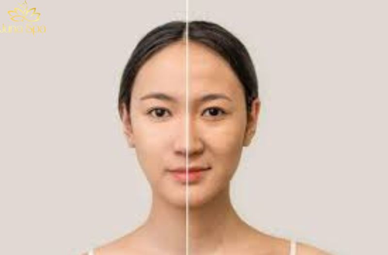 Xuất hiện nếp nhăn nhỏ ở vùng mắt hoặc khóe miệng