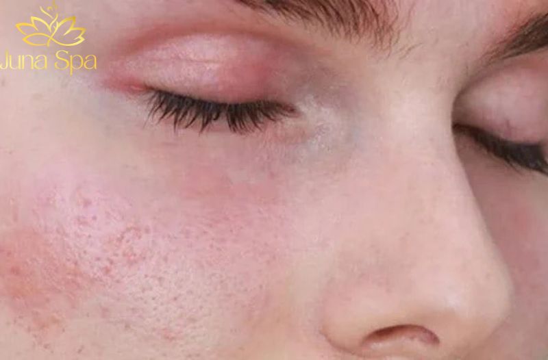 Dấu hiệu cho thấy da chỉ đang “nhạy cảm tạm thời”
