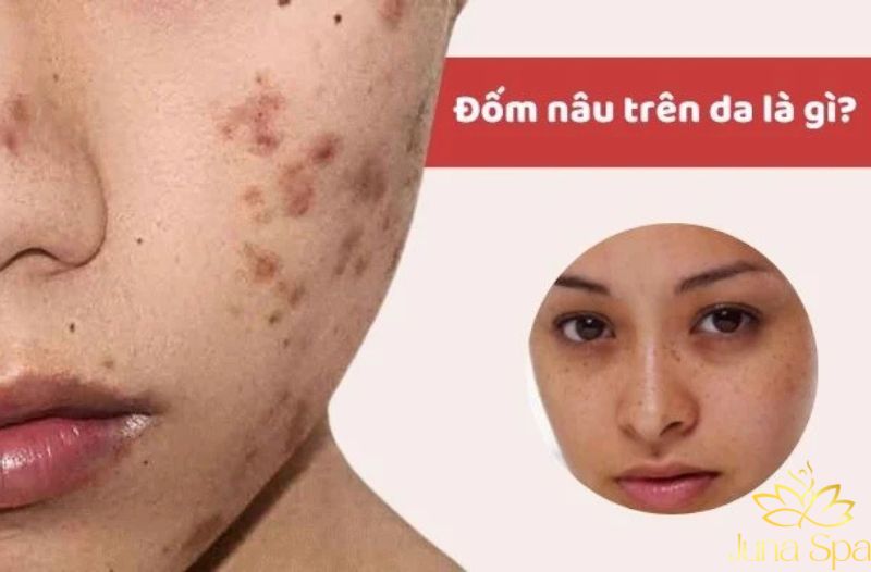 Vì sao da sau tuổi 25 dễ xuất hiện đốm nâu hơn?