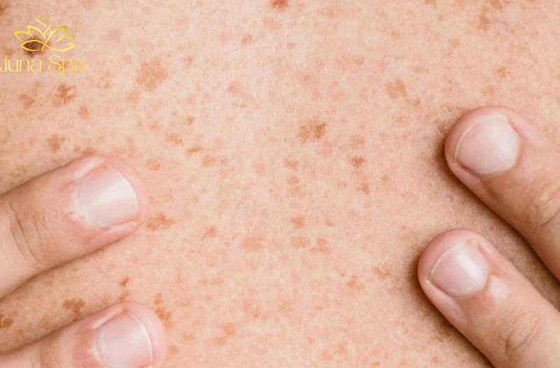 Những nguyên nhân khiến đốm nâu dễ xuất hiện hơn