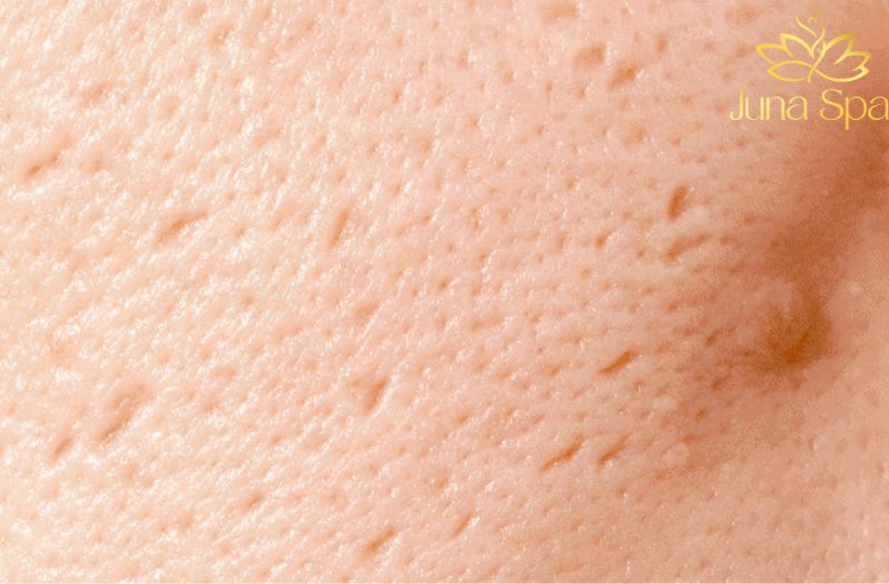 Sẹo rỗ là gì và vì sao khó cải thiện triệt để