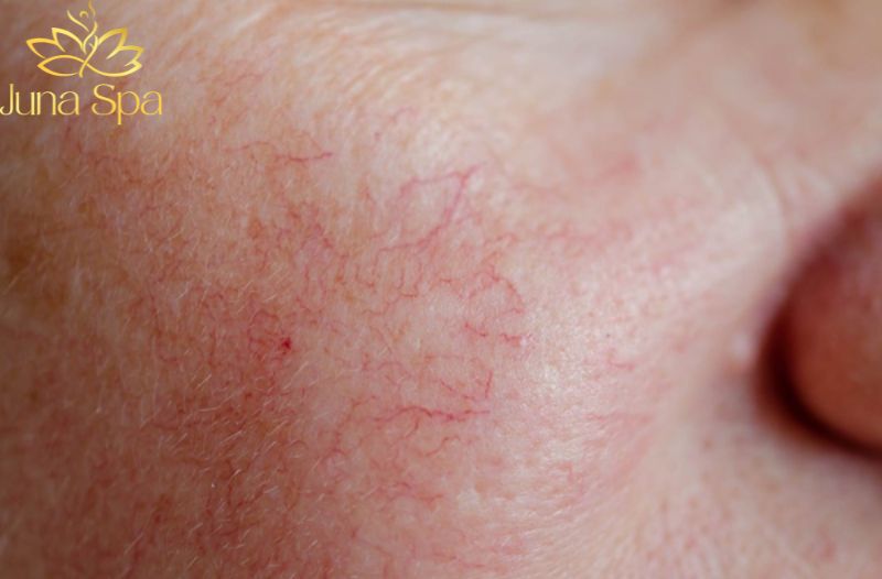 Dấu hiệu nhận biết da đang bị mỏng yếu