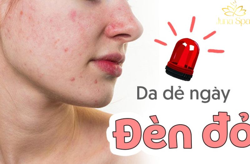 Vì sao da dễ nổi mụn trong những ngày “đèn đỏ”