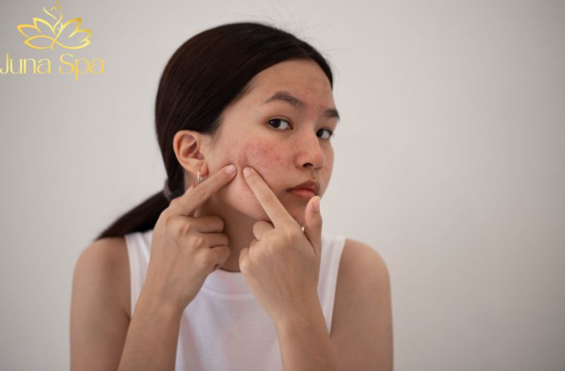 Da mụn không chỉ là vấn đề trên bề mặt da