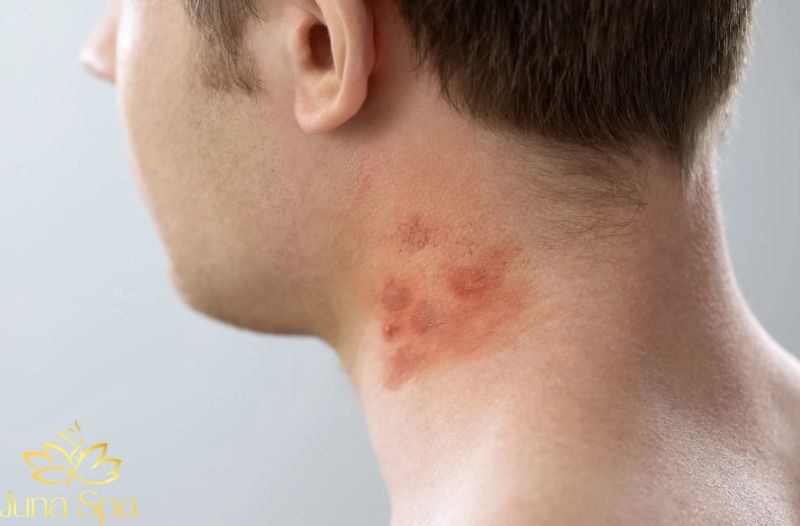 Lỗ chân lông dễ bị bít tắc