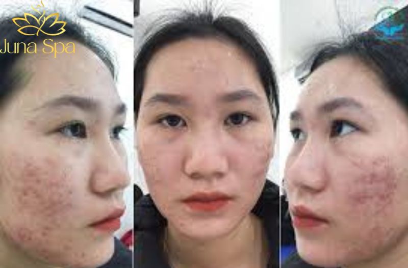 Vì sao ngày càng nhiều người gặp tình trạng mụn