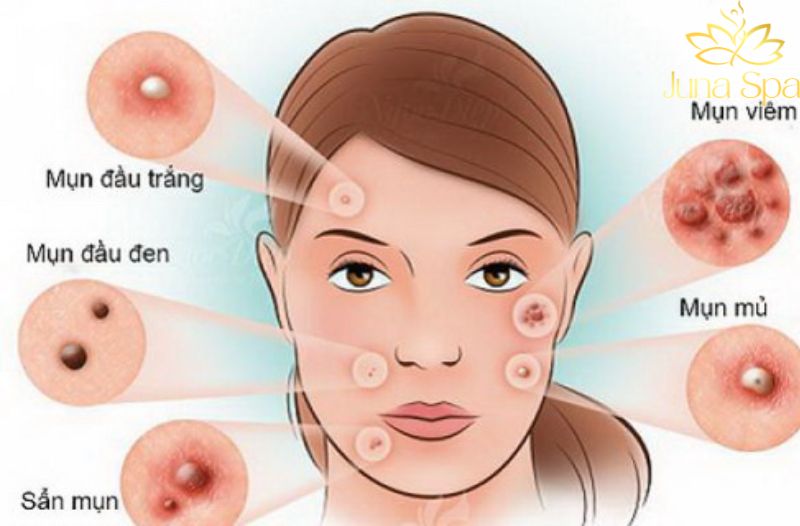 Khi lựa chọn địa điểm trị mụn Tân Phú, nhiều người thường quan tâm điều gì